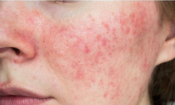 Täck rosacea med smink: Få den där felfria looken igen